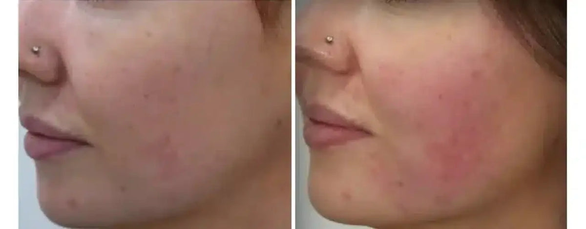 PRP Therapy for Acne Scars: Dark Under Eye Circles, Hair Restoration