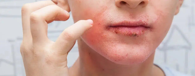 From Parched to Perfect: Your Ultimate Guide to Treating Dry and Rough Skin