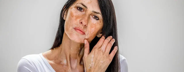 Vitiligo Demystified: From Myths to Miracles