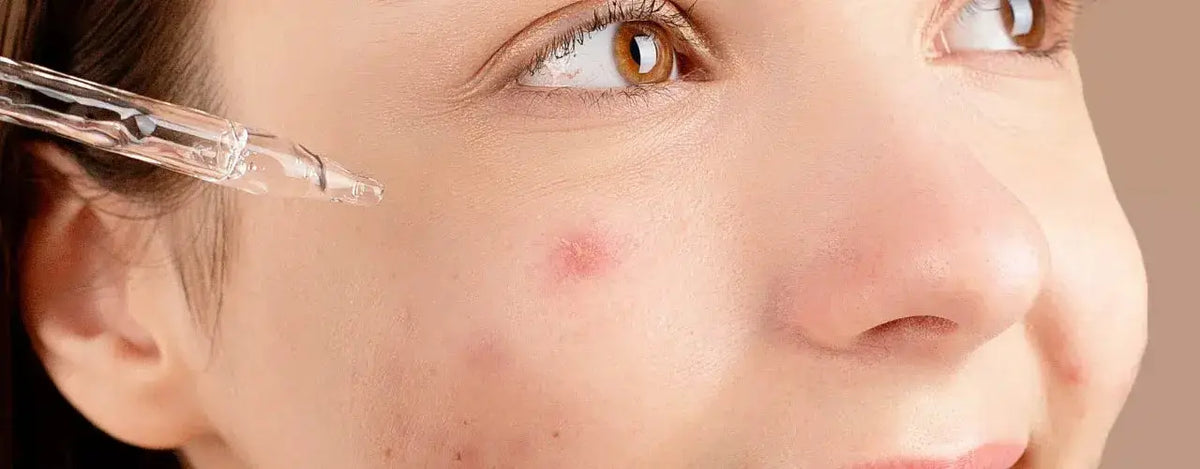 NiaRonic Acne Control Serum: Your Solution for Clear and Radiant Skin