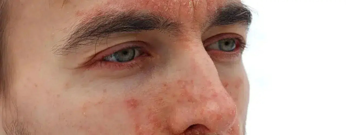 Seborrheic Eczema: Conquer Flaky Scalp & Itchy Skin