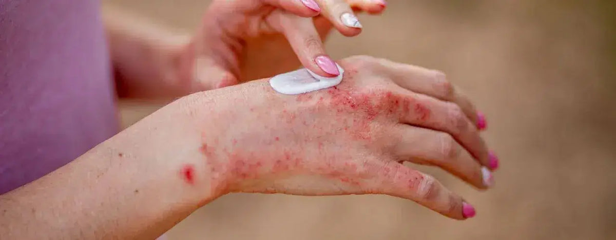Stop the Itch! Ultimate Guide to Hand Eczema Relief & Treatment