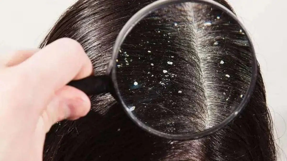 Dandruff Treatment: 7 Effective Ways to Stop Flakes Fast