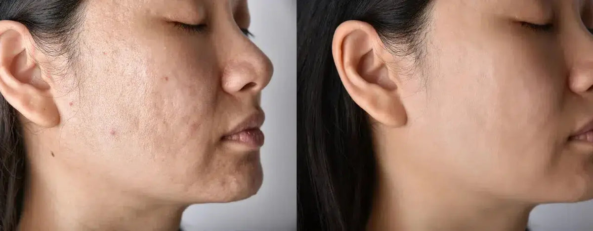 ACNESAN Sebum Control Gel: Your Solution for UV Protection and Sebum Control