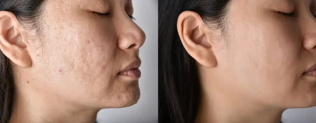 ACNESAN Sebum Control Gel: Your Solution for UV Protection and Sebum Control
