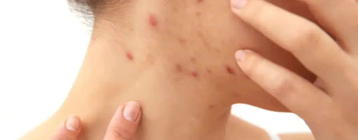 Scabies Relief: Stop the Itch in its Tracks