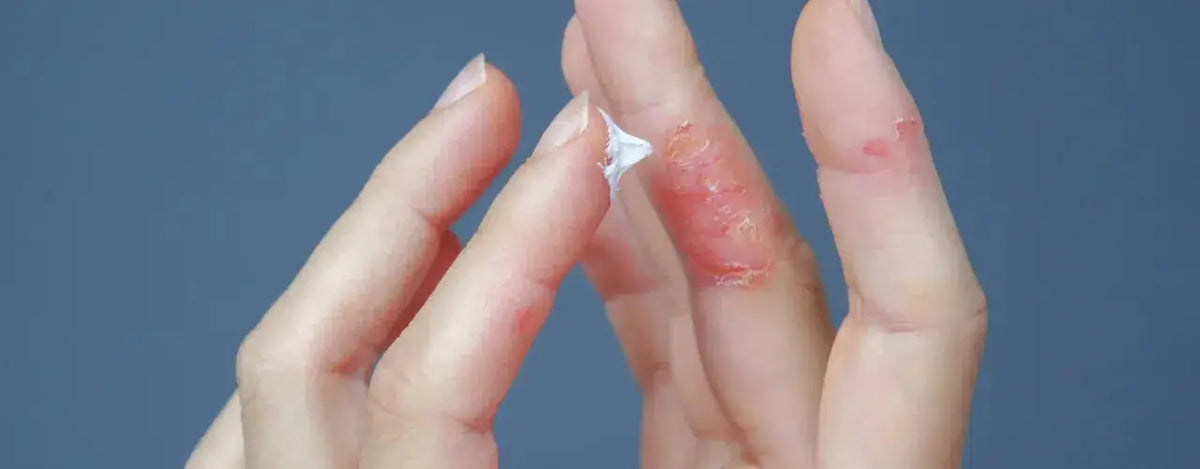 Onvate Lotion: Your Topical Solution for Atopic Dermatitis Relief