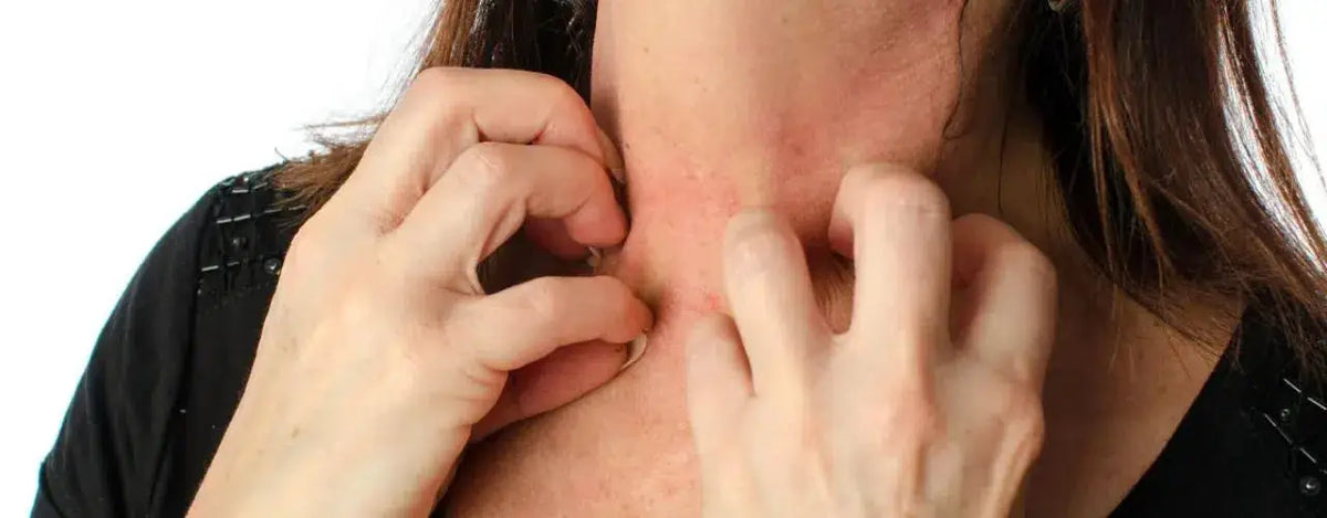 Conquering the Itch: Understanding and Managing Urticaria (Hives)