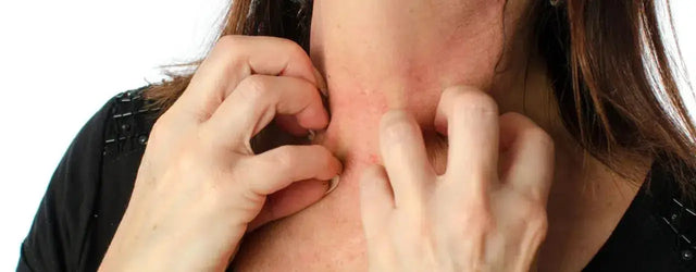 Conquering the Itch: Understanding and Managing Urticaria (Hives)