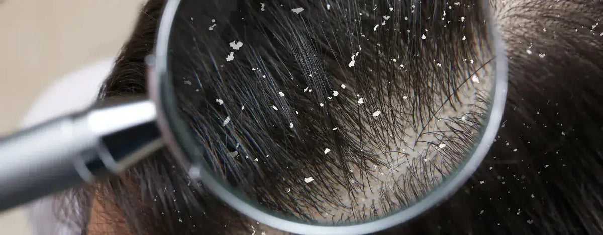 Say Goodbye to Dandruff with Photonic Anti-Dandruff Shampoo