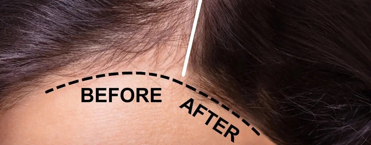 Diffuse Hair Loss in Women: Understanding the Cause & Finding Solutions