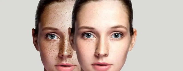 Freckles: From Faded to Flawless - Your Guide to Pico Laser Treatment