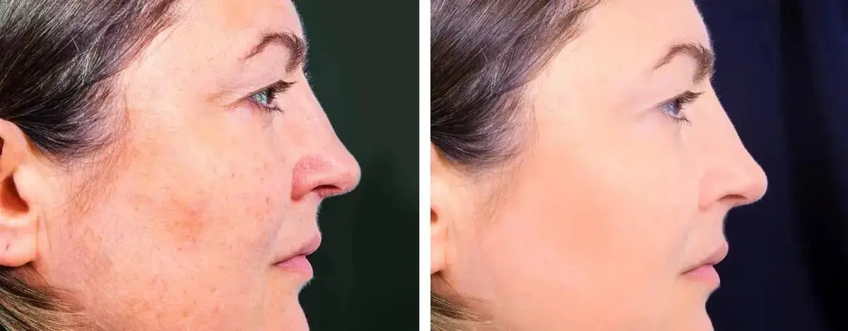 Open Pores: Role Of Lasers in Treatment Using Laser Technology