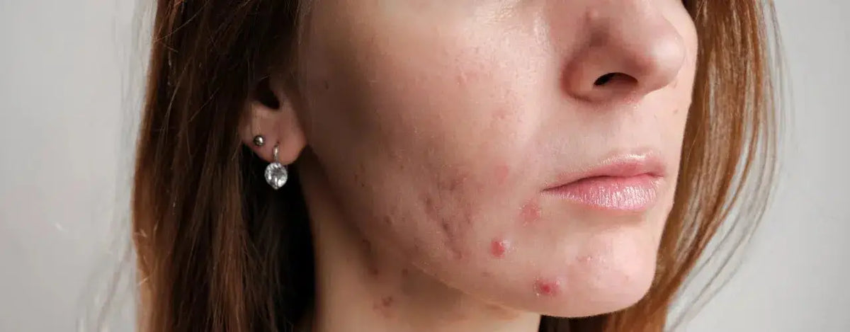 Simple Tips for Managing Acne Naturally