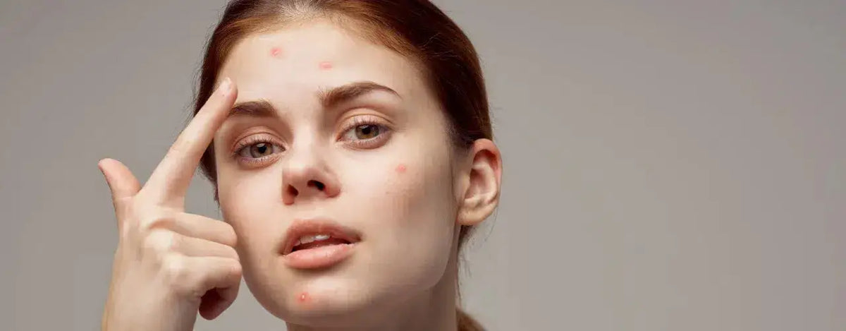 Revealing the Truth: Sorting Acne Treatment Myths from Reality