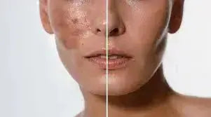 Best Acid for Hyperpigmentation: Top Effective Products to Try Now