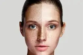 Melasma on Face: A Complete Guide to Location Specific Treatment
