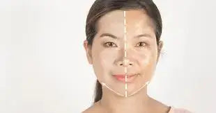 Microneedling for Melasma: A Complete Guide to Effective Treatment