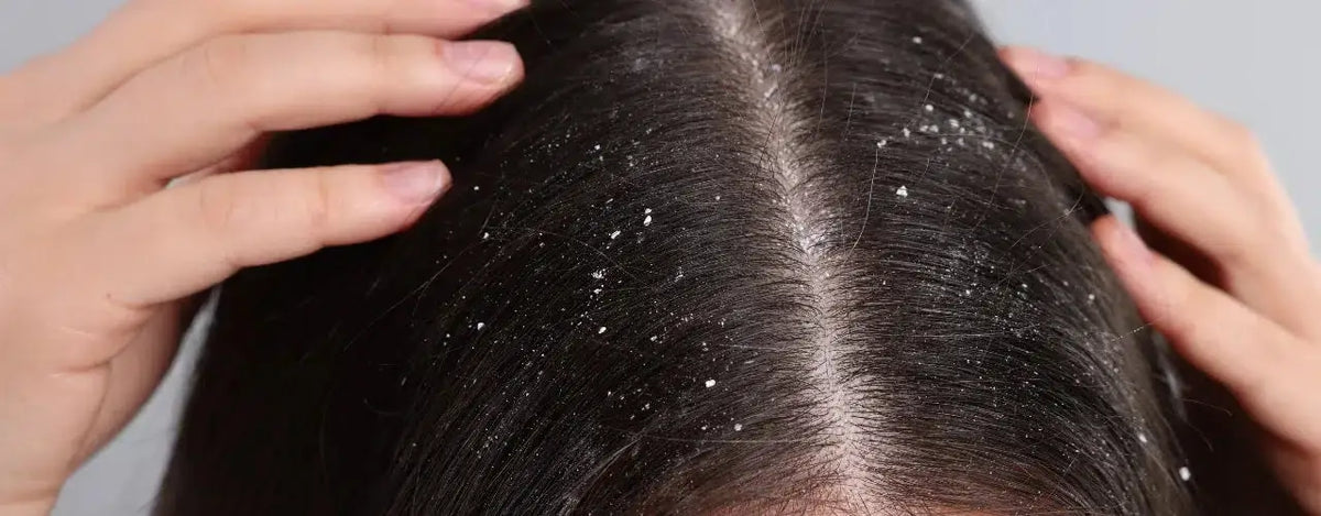 Hair Fall, Dandruff, and Dryness - Euthrix Has Got You Covered