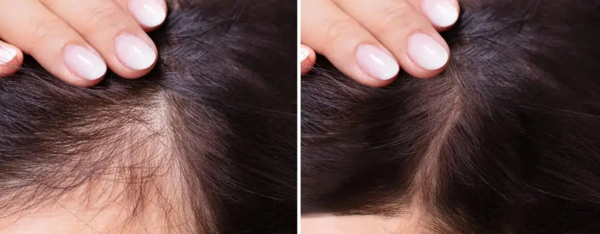 Understanding Hair Loss: Exploring Causes, Treatments, and Prevention