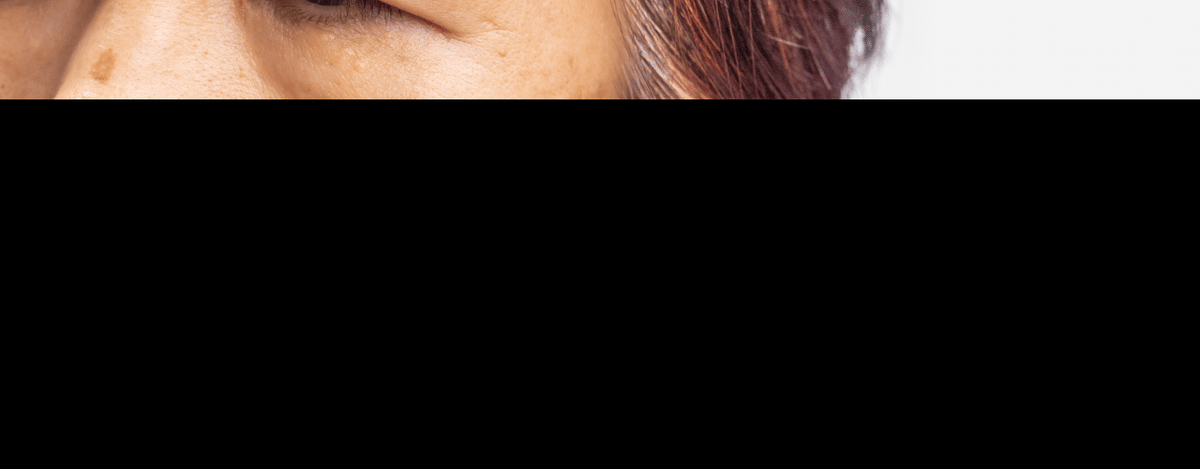 Understanding High Pigmentation on the Face and Effective Skincare Solutions