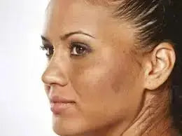 Hyperpigmentation Body Treatment: A Complete Guide to Clearer Skin