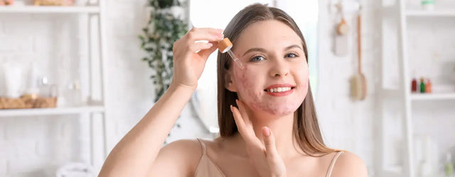 MANDY Mandelic Acid Serum: The Ultimate Solution for Acne Breakouts