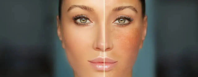 BioRePeel for Melasma: Emerging Treatment Option