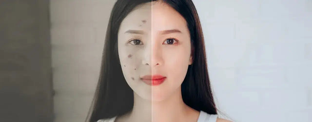 ACNI SOL Face Wash: Your Ultimate Solution for Acne-Free, Healthy Skin