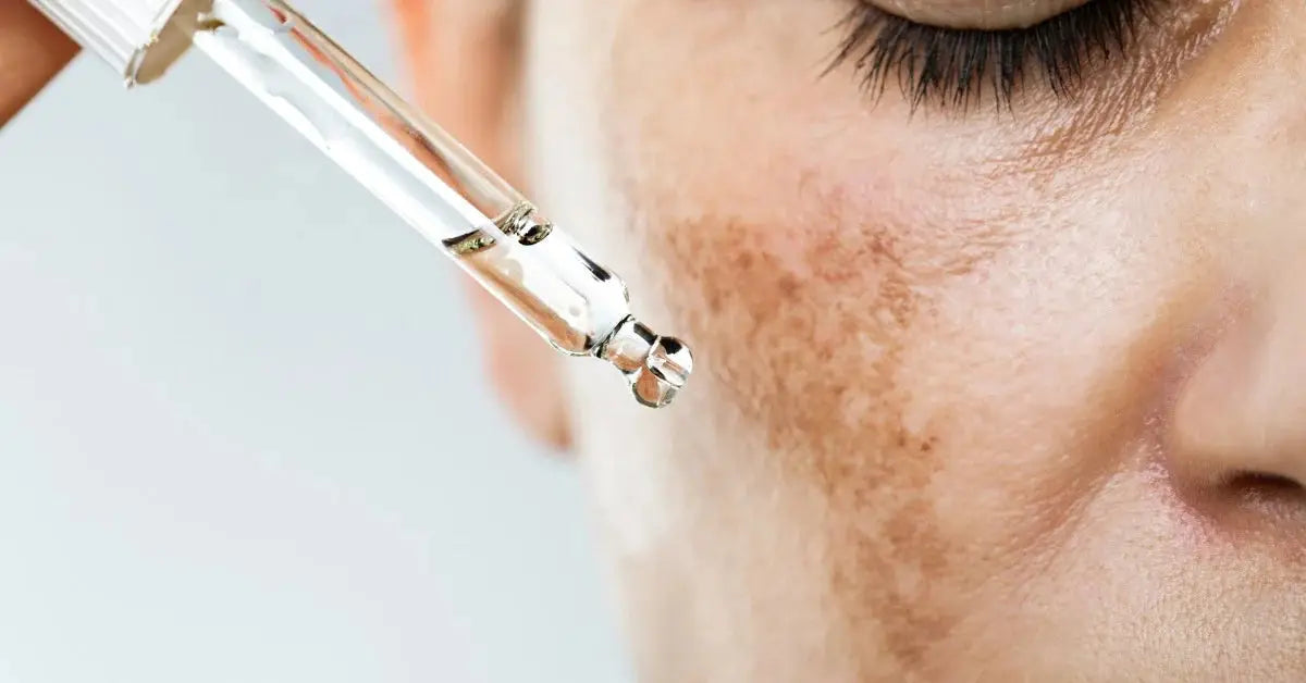 Melasma Treatment Cream in Pakistan: Top Picks & Prices