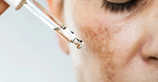 Melasma Treatment Cream in Pakistan: Top Picks & Prices