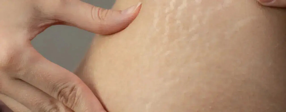 StriDerm Stretch Marks Lotion: Banish Stretch Marks with Confidence