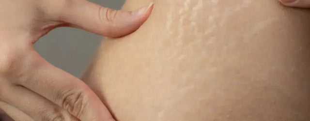 StriDerm Stretch Marks Lotion: Banish Stretch Marks with Confidence