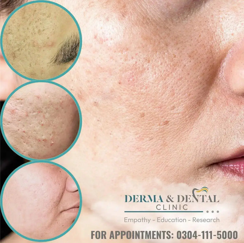 Erase Acne Scars and Unveil Your Radiant Skin: Skin Clinic by Dr. Eram Razzaq's Expert Solutions
