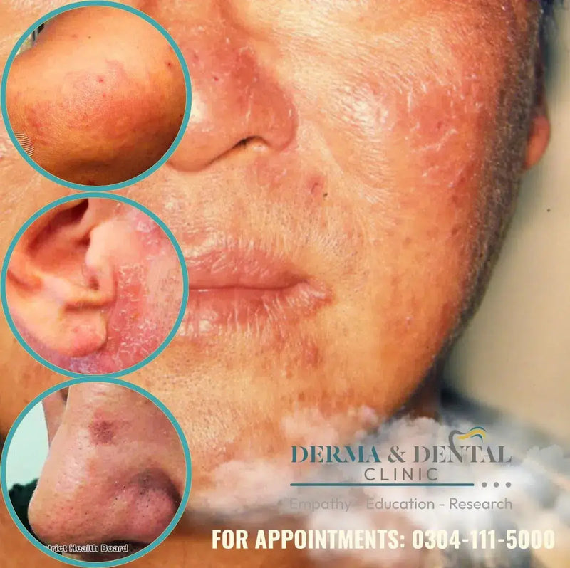 Find Relief from Chronic Actinic Dermatitis at Skin Clinic by Dr. Eram Razzaq