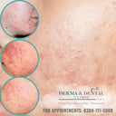 Conquer Nodulocystic Acne with Skin Clinic by Dr. Eram Razzaq: Your Path to Clear, Healthy Skin photo 1