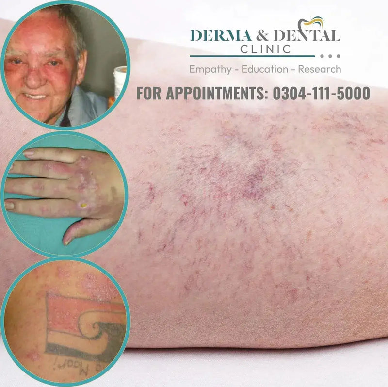 Photodermatitis: Causes, Symptoms, and Treatment Options at Skin Clinic by Dr. Eram Razzaq