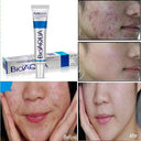 BIOAQUA 2 Pcs Anti Acne Scar Mark Remover Acne Scar Removal Cream photo 4