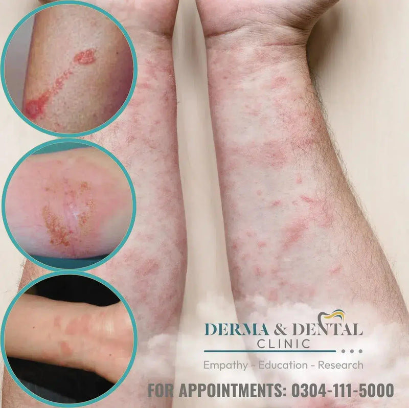 Contact Eczema Treatment in Lahore | Derma.pk