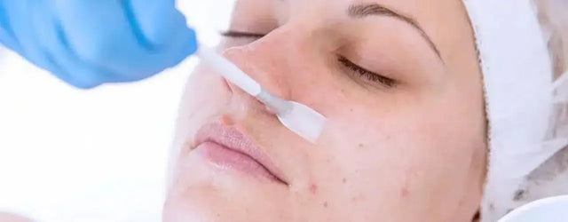 Chemical Peeling: Get Glowing Skin You Deserve