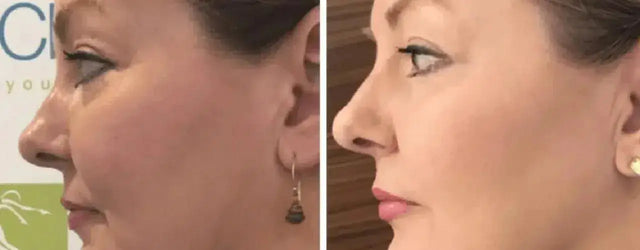 HIFU: The Non-Surgical Facelift Revolution