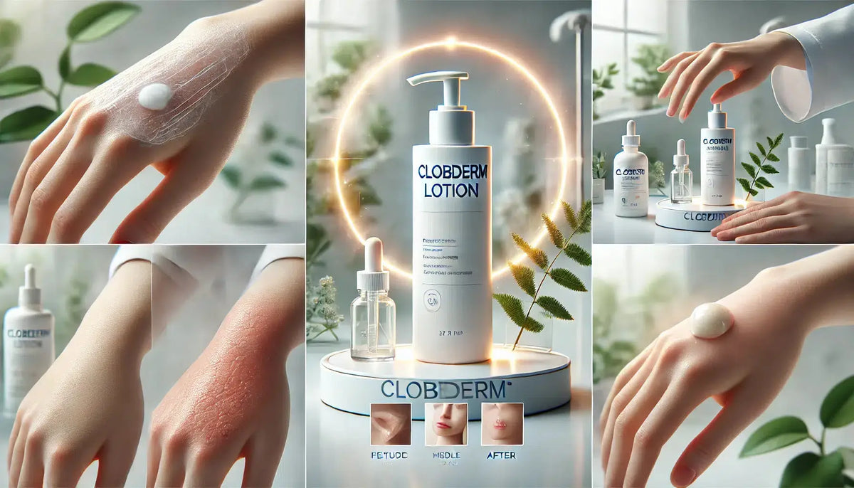 Fast and Effective: The Key Uses of Clobederm Lotion