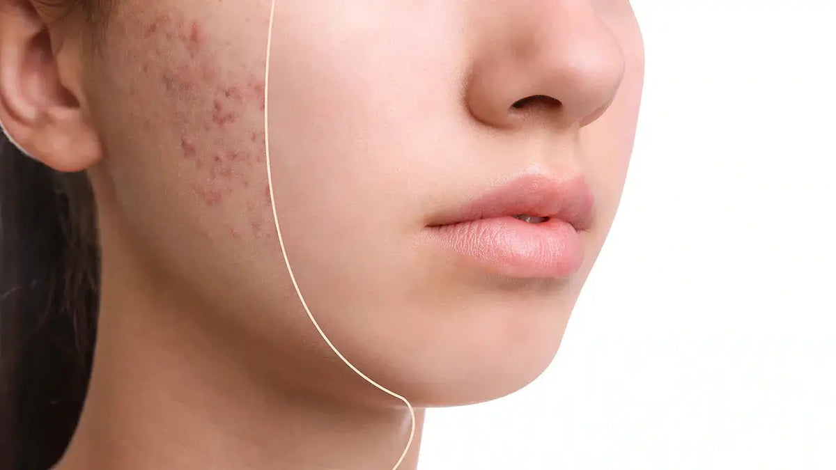 MandelAC Serum: Your Solution for Acne, Brightening, and Wrinkle Reduction