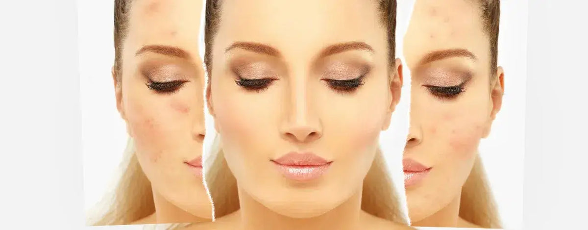 Tips for Clearer Acne Prone Skin