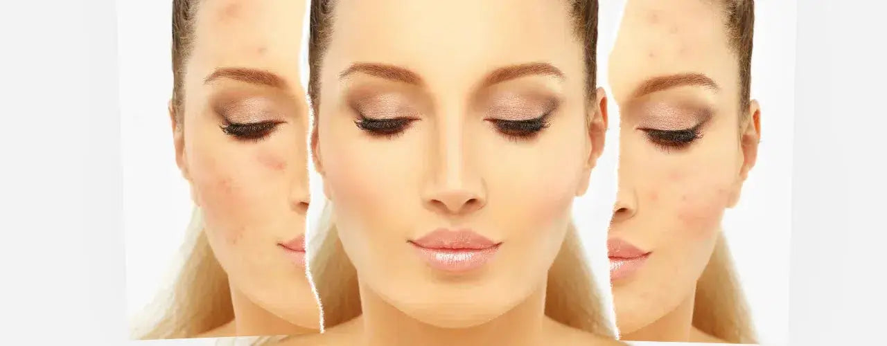 Acne-Prone Skin