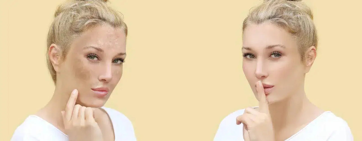 Age Spot Reduction: Tips and Remedies