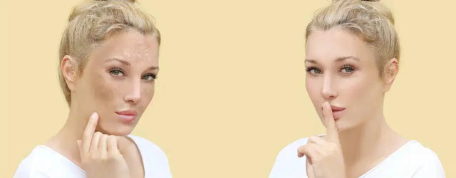 Age Spot Reduction: Tips and Remedies