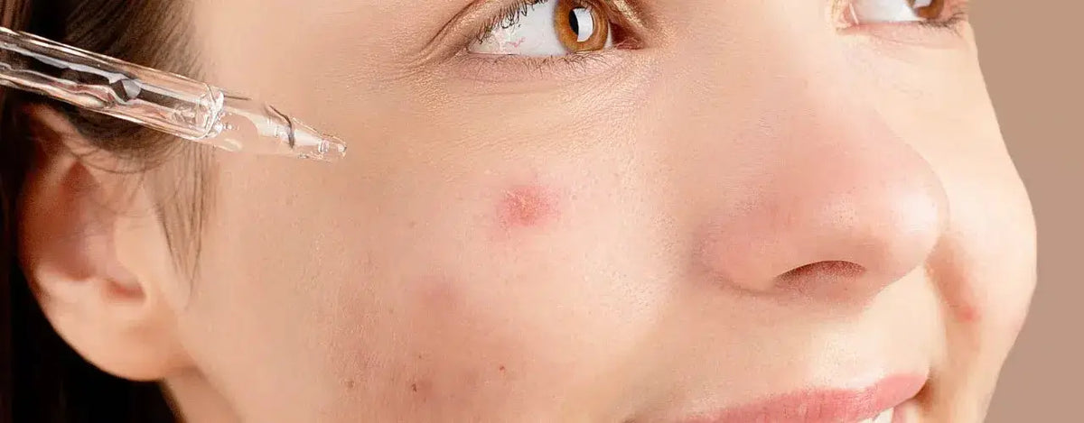 Maz Clarity Advanced Anti Acne Serum: Your Solution for Clearer Skin