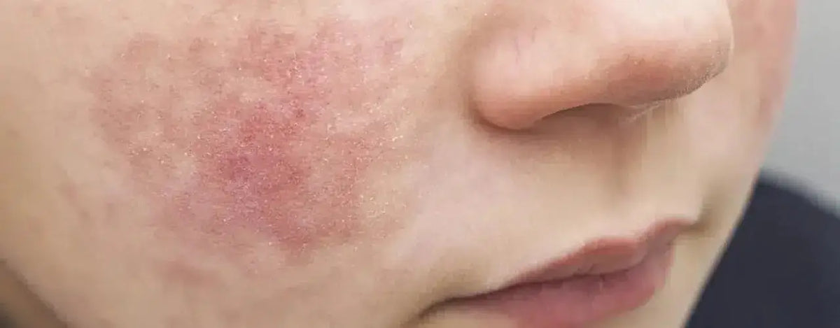 Living with Atopic Eczema: Practical Strategies for Everyday Life