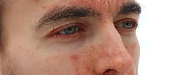 Seborrheic Eczema: Conquer Flaky Scalp & Itchy Skin